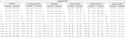 Genotype/Phenotype Relationship in a Consanguineal Family With Brugada Syndrome Harboring the R1632C Missense Variant in the SCN5A Gene